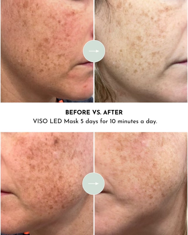 Lumara VISO Red Light Therapy Mask – feature detail