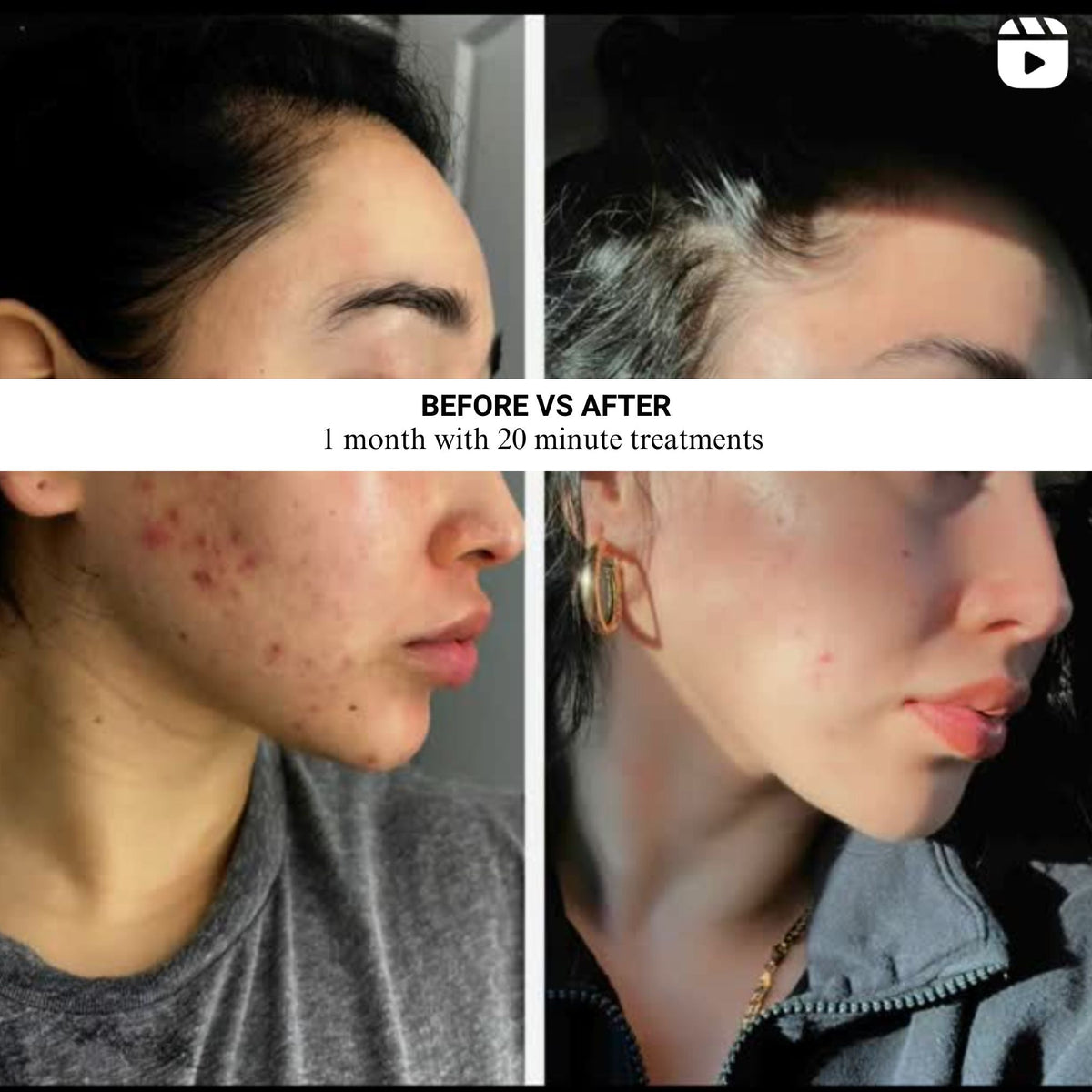 Lumara VISO Red Light Therapy Mask – feature comparison